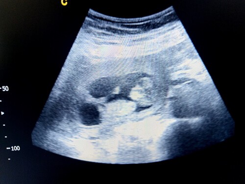 10 week fetus